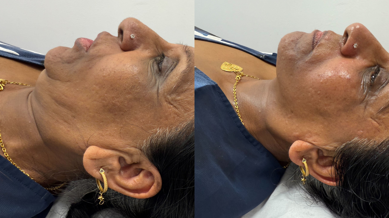 Avalon Skin Clinic result 1