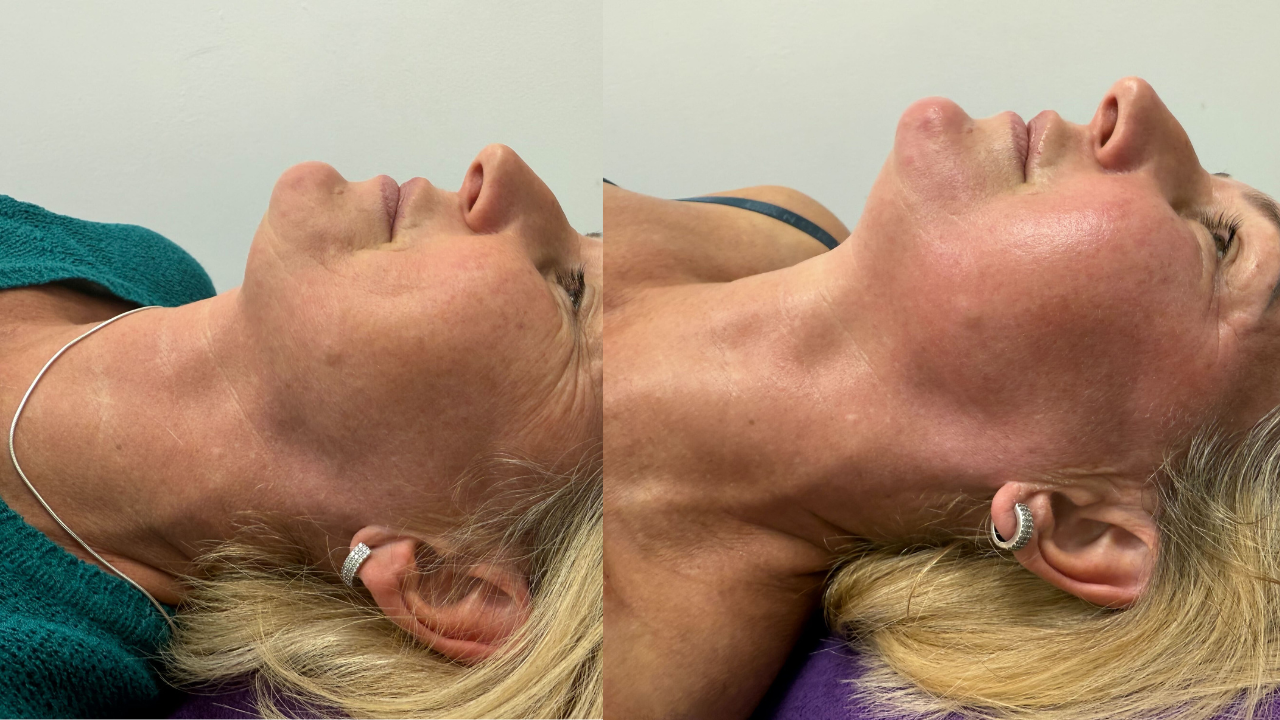 Avalon Skin Clinic result 2