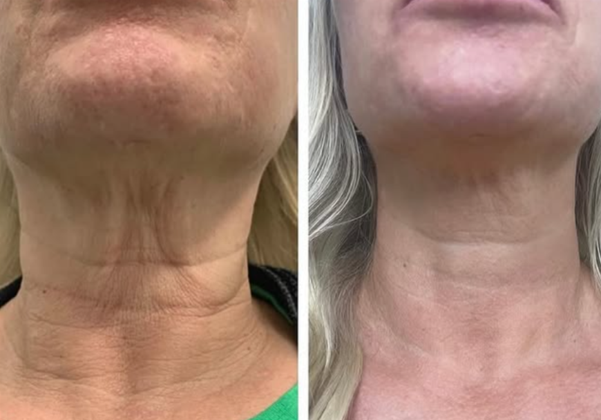 Avalon Skin Clinic result 3