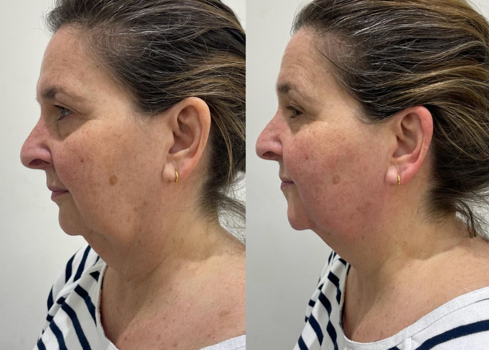 Avalon Skin Clinic result 4