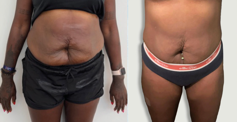 Before and after result 3