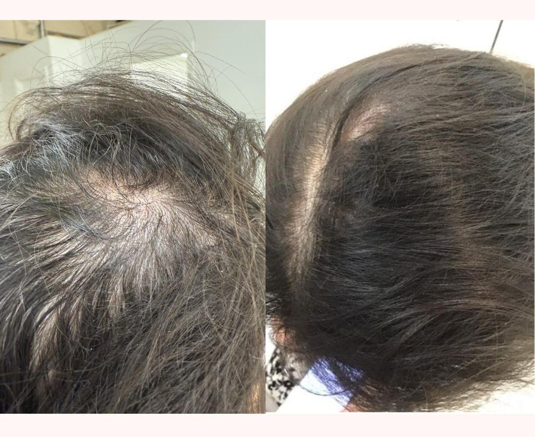 PRP Hair Restoration result 1