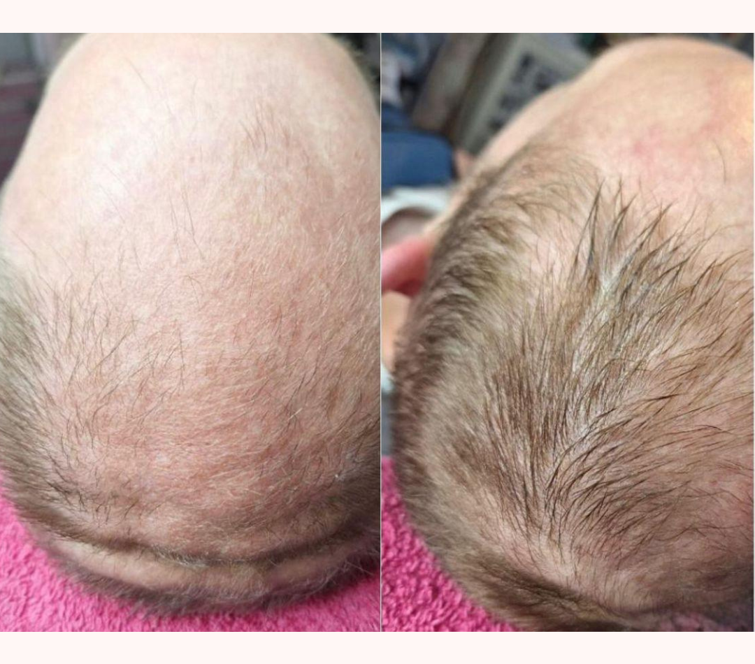 PRP Hair Restoration result 4